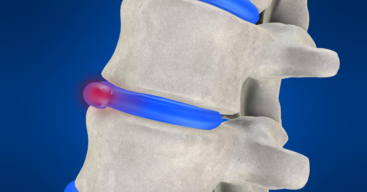 Burton, MI non-surgical disc herniation treatment